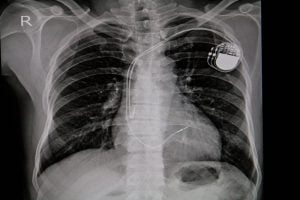 Chest x-ray image of a permanent pacemaker implanted in the chest