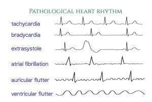 Illustration of different types of irregular heart rhythms