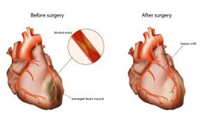 Coronary artery bypass surgery
