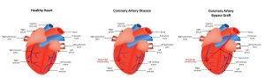 Heart after coronary artery bypass surgery