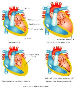 Types of cardiomyopathy