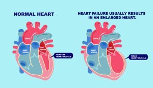 Enlarged heart and heart failure
