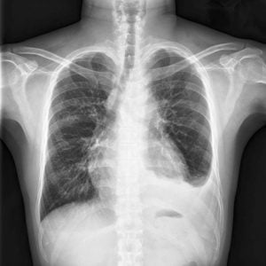 Enlarged heart (Cardiomegaly)