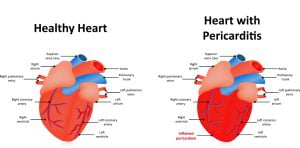 What is pericarditis?