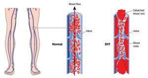 Drawing showing deep vein thrombosis in leg veins