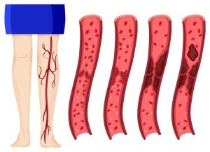 Blood clot in human legs illustration (deep vein thrombosis image)