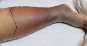 Lower limb deep vein thrombosis in a leg of a patient