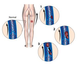 Normal condition vs DVT in leg