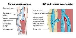 Normal flow vs deep vein thrombosis (DVT) and venous hypertension