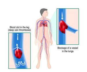 Pulmonary embolism image