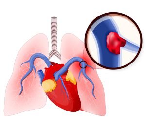 Pulmonary embolism and deep vein thrombosis (DVT)