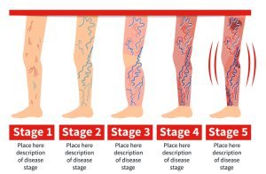 Stage of vein diseases