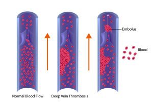 Deep vein thrombosis or blood clots (Embolus)
