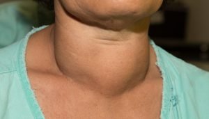 Goiters and thyroid cancer