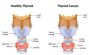 Thyroid cancer image