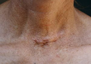 Thyroid surgery image