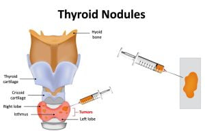 Fine needle aspiration of thyroid nodules