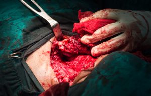 Thyroidectomy