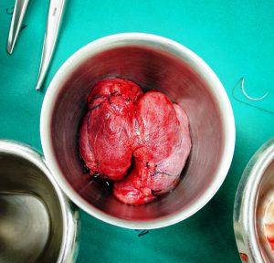 Thyroid nodules removed after surgery