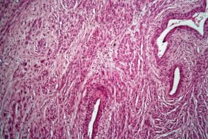 Microscopic view of uterine fibroids in a patient
