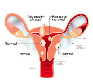 Types of uterine fibroids