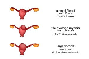 Classification of size of fibroids