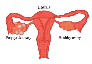 Illustration of a female disease - Polycystic ovary syndrome
