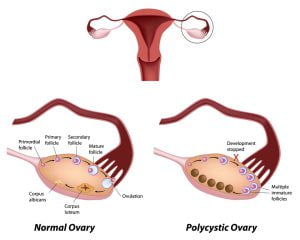 Normal ovarian cycle and Polycystic ovary syndrome