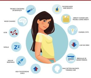 Symptoms of polycystic ovary syndrome