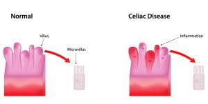 Celiac disease