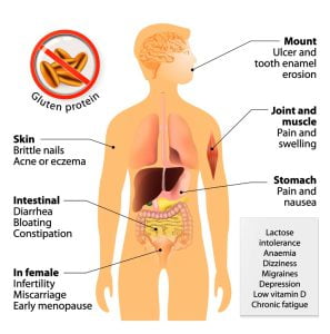 Celiac disease signs and symptoms