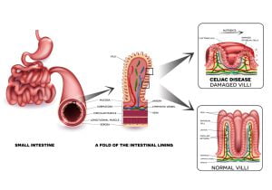 Damaged intestinal lining due to celiac disease
