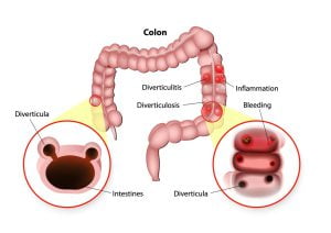 Diverticulosis and diverticulitis