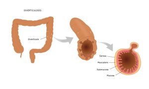 What is diverticula?