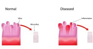 Irritable bowel syndrome