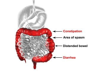 Causes of irritable bowel syndrome