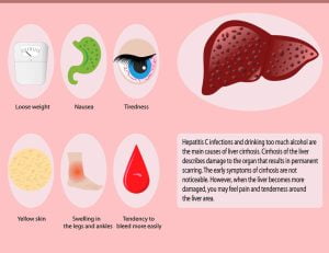 Symptoms of cirrhosis