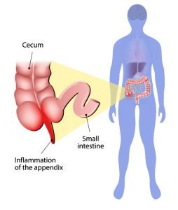 Appendicitis image