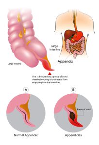 Normal appendix vs appendicitis