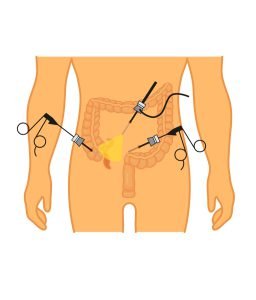 Appendectomy