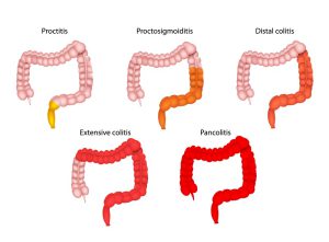 Types of ulcerative colitis