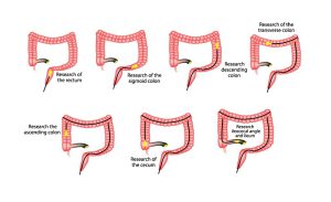Colonoscopy