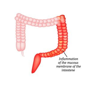 Inflammation of the intestine