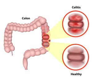 Colitis refers to the inflammation of inner lining of the colon