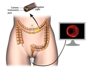 In a colonoscopy, the examiner uses a colonoscope, which is a long, flexible, tubular instrument