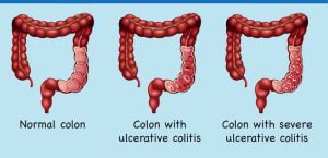 Normal colon vs colon with ulcerative colitis