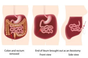 Proctocolectomy with brooke ileostomy