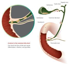 A stone in the common bile duct