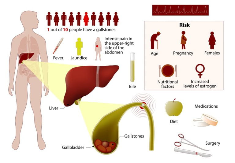 Can Bone Cancer Cause Limb Amputation? Risk of gallstones