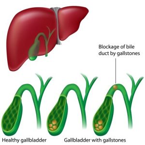 Healthy gallbladder vs gallbladder with stones